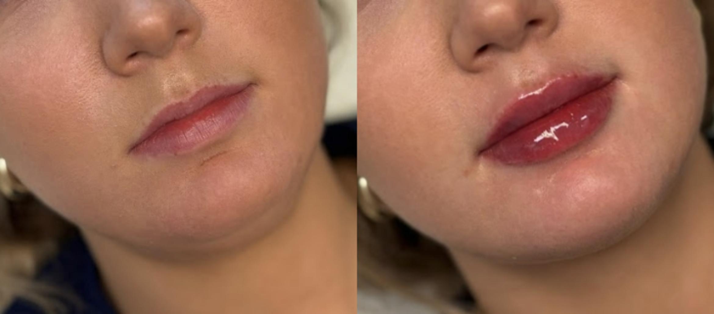 Before & After Injectables & Fillers Case 28320 Front View in Atlanta, GA