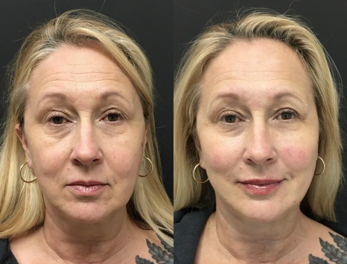 Before & After Injectables & Fillers Case 28321 Front View in Atlanta, GA