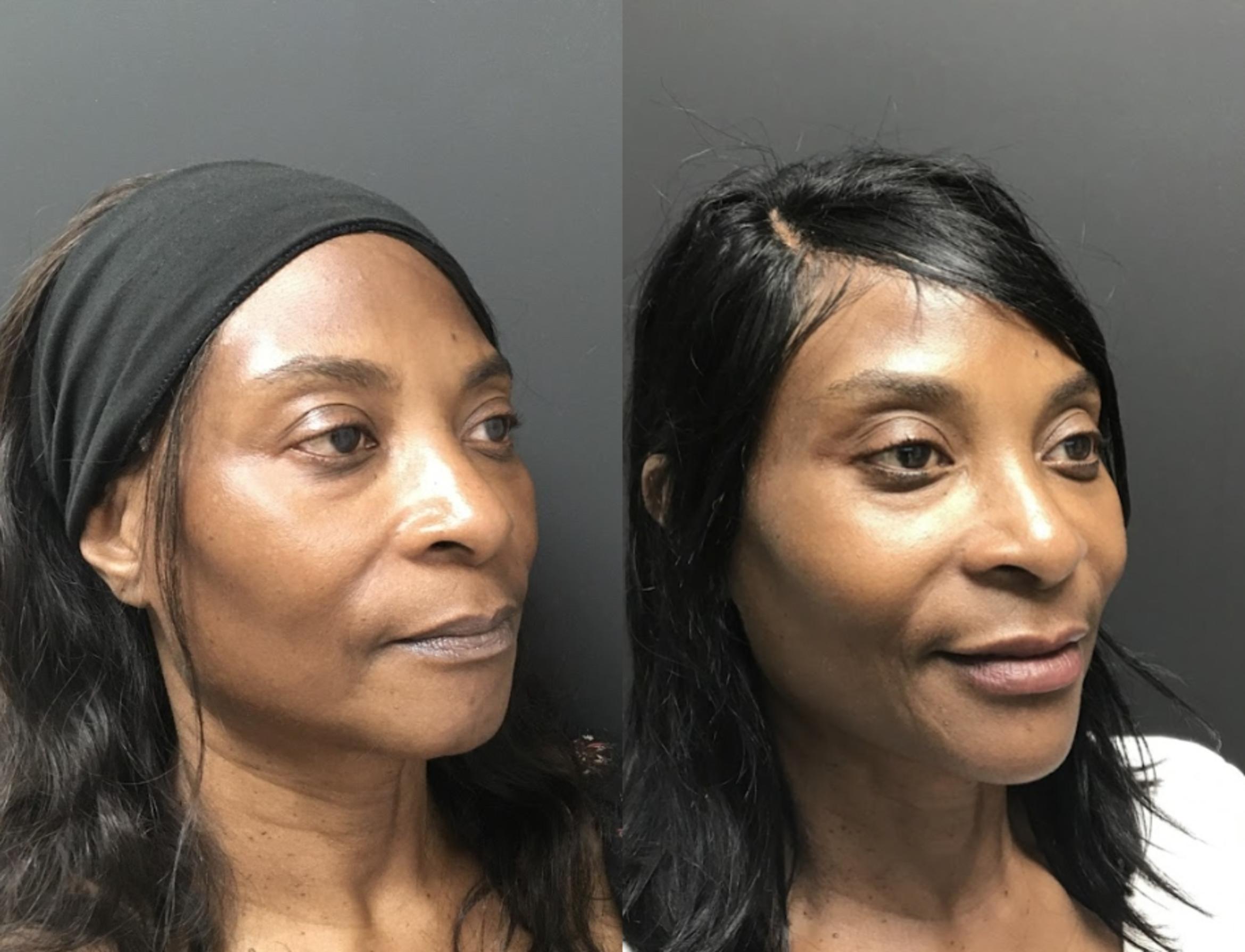Before & After Injectables & Fillers Case 28322 Right Side View in Atlanta, GA