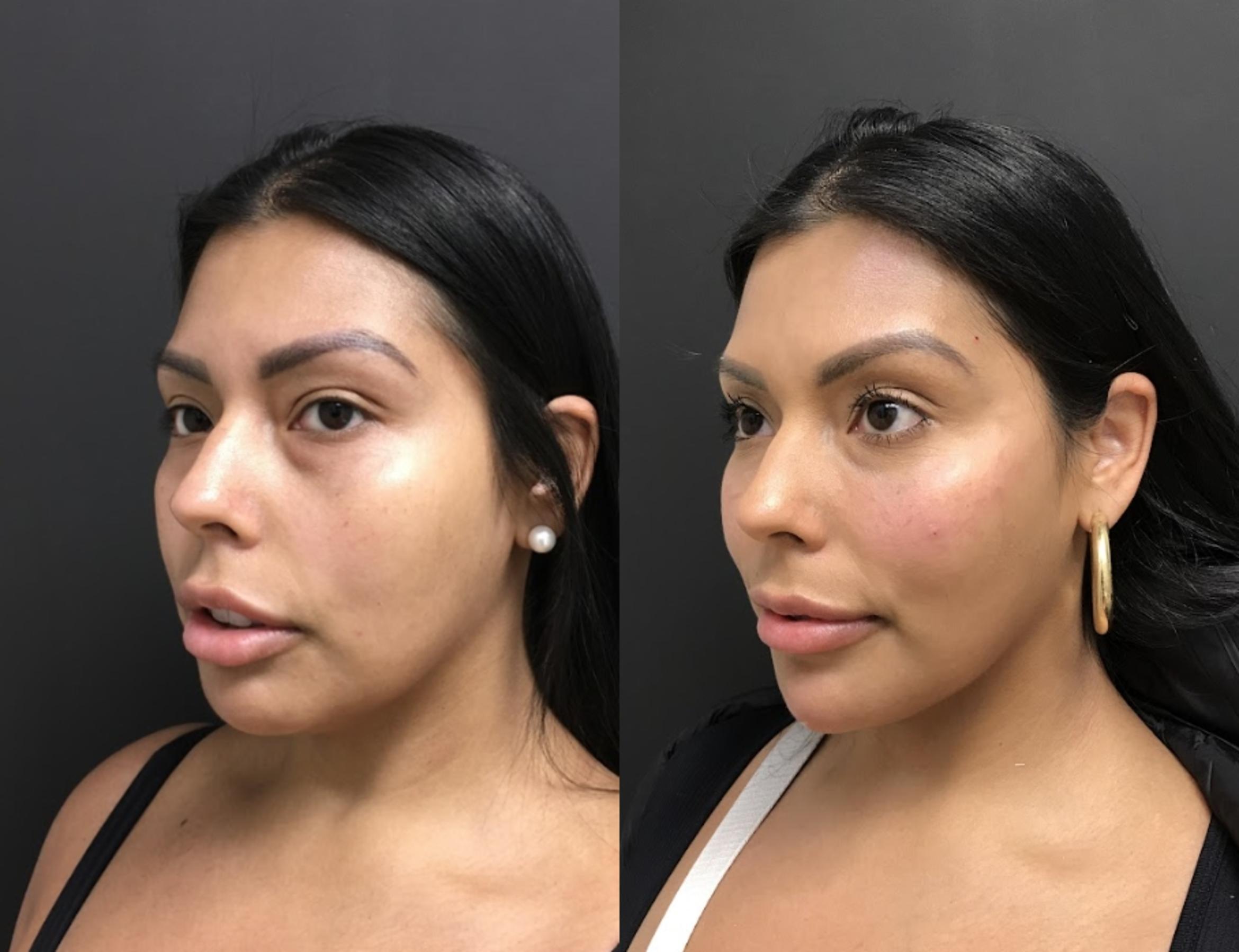Before & After Injectables & Fillers Case 28323 Left Side View in Atlanta, GA