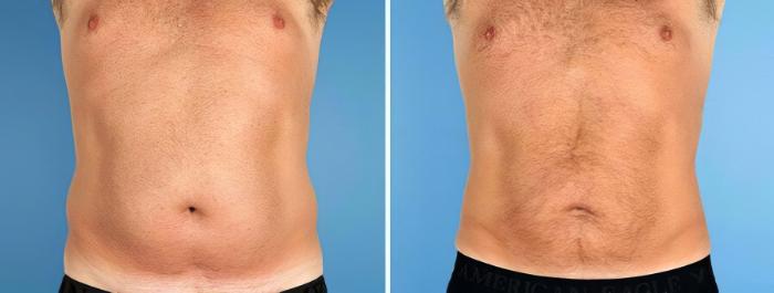 Before & After Liposuction Case 17520 View #1 View in Alpharetta, GA