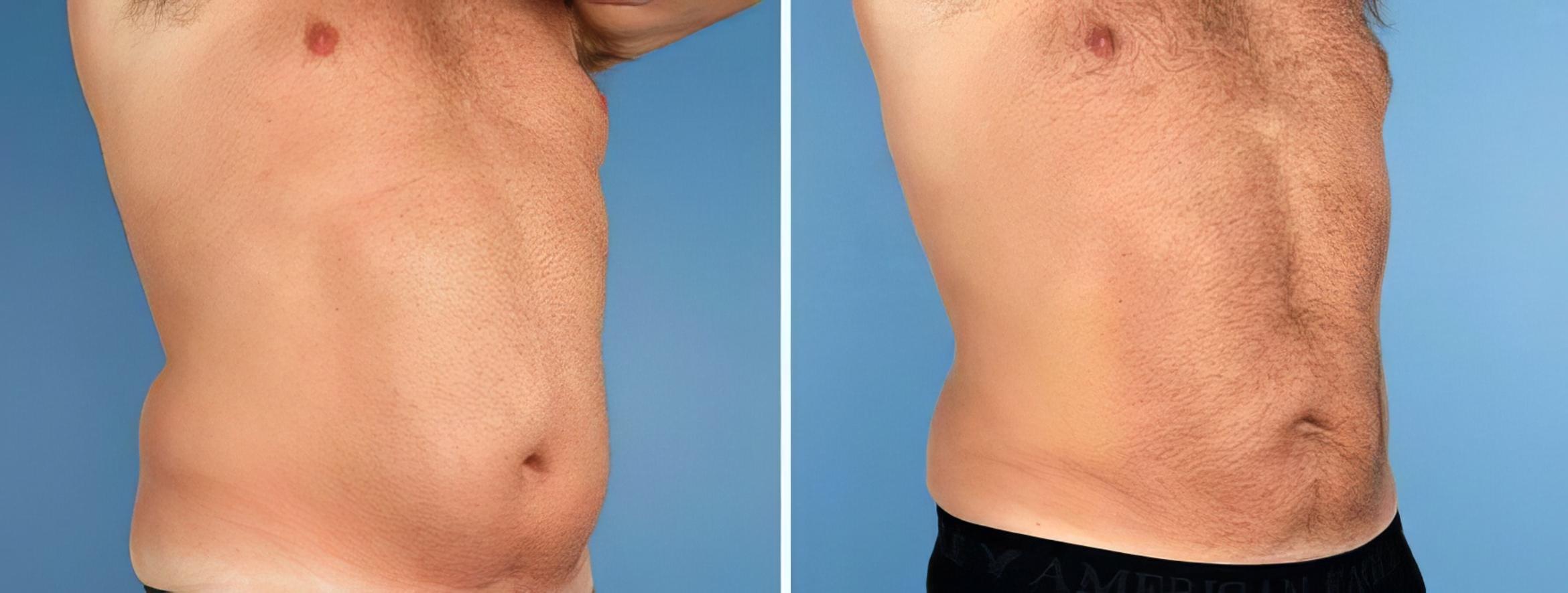 Before & After Liposuction Case 17520 View #2 View in Atlanta, GA