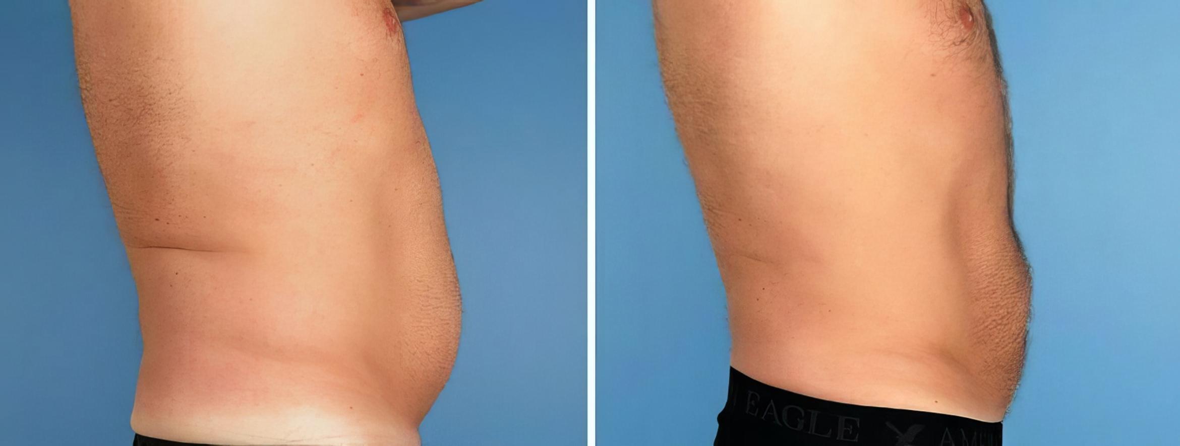 Before & After Liposuction Case 17520 View #3 View in Atlanta, GA