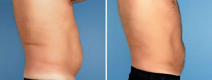 Before & After Liposuction Case 17520 View #3 View in Alpharetta, GA