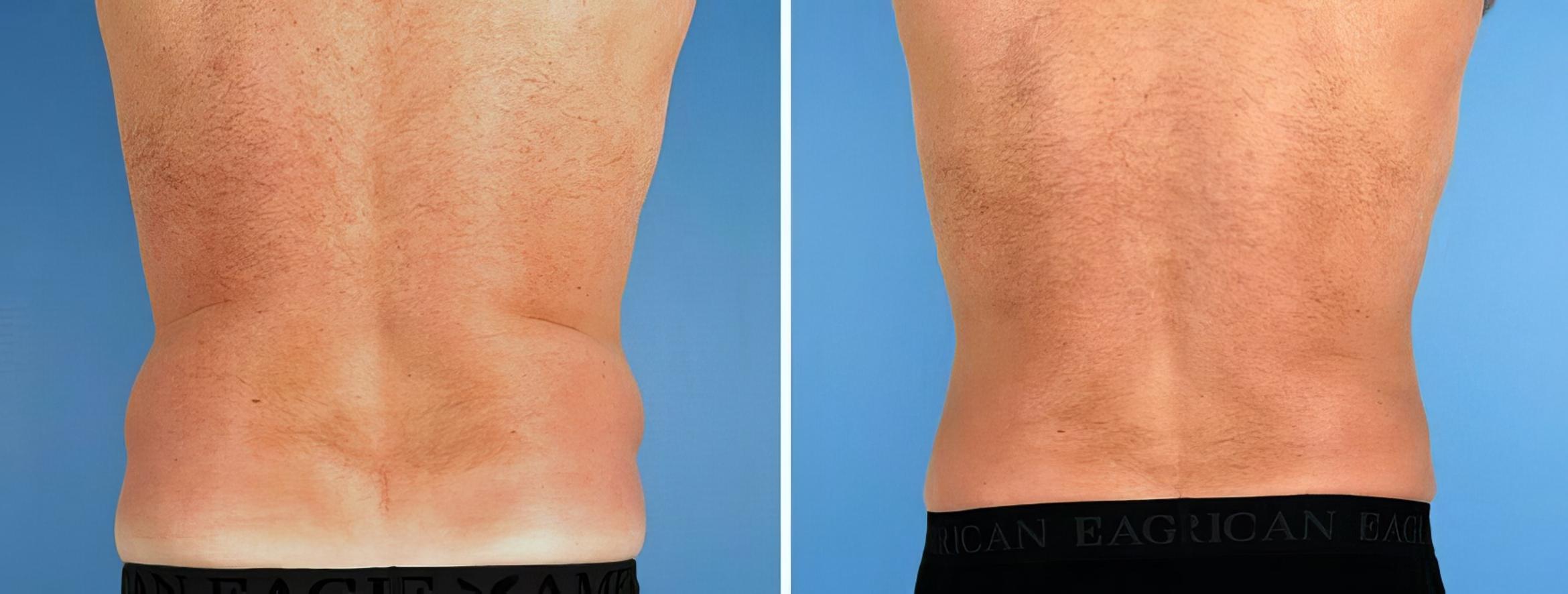 Before & After Liposuction Case 17520 View #4 View in Atlanta, GA