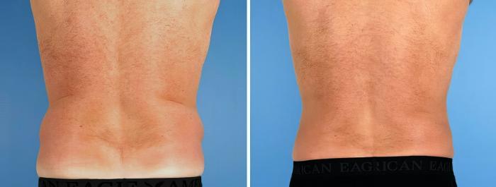 Before & After Liposuction Case 17520 View #4 View in Alpharetta, GA