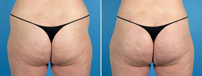 Before & After Liposuction Case 17525 View #1 View in Alpharetta, GA