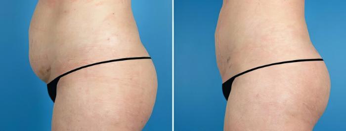 Before & After Liposuction Case 17525 View #2 View in Alpharetta, GA
