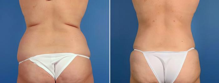 Before & After Liposuction Case 17528 View #1 View in Alpharetta, GA