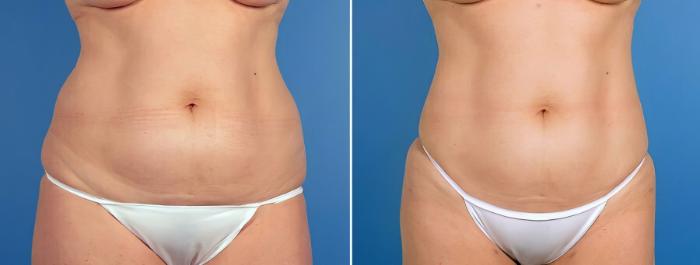 Before & After Liposuction Case 17528 View #2 View in Alpharetta, GA