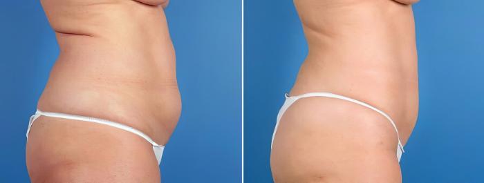 Before & After Liposuction Case 17528 View #3 View in Alpharetta, GA