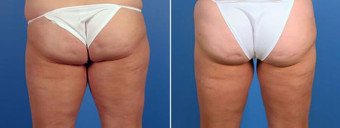 Before & After Liposuction Case 17528 View #4 View in Alpharetta, GA