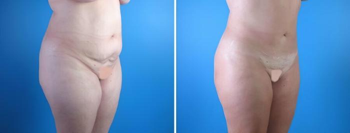 Before & After Liposuction Case 17969 View #1 View in Alpharetta, GA