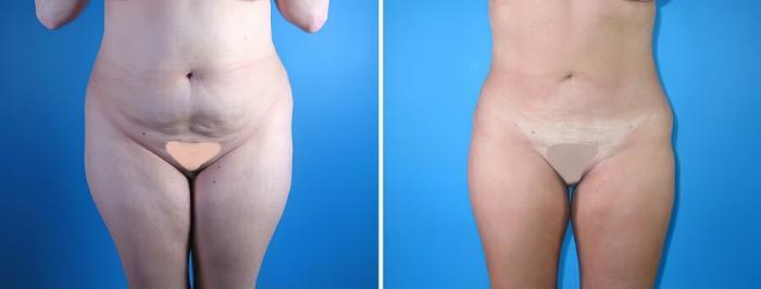 Before & After Liposuction Case 17969 View #2 View in Alpharetta, GA