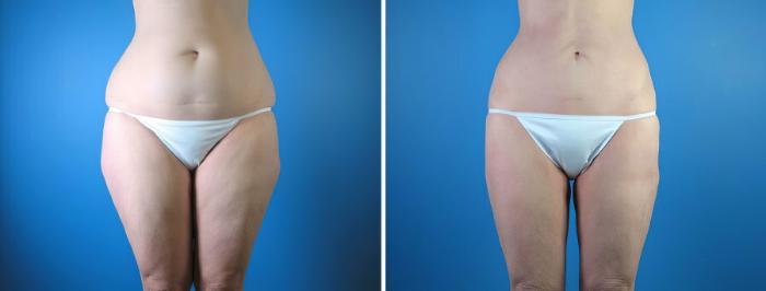 Before & After Liposuction Case 17975 View #2 View in Alpharetta, GA
