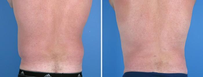 Before & After Liposuction Case 17978 View #1 View in Alpharetta, GA