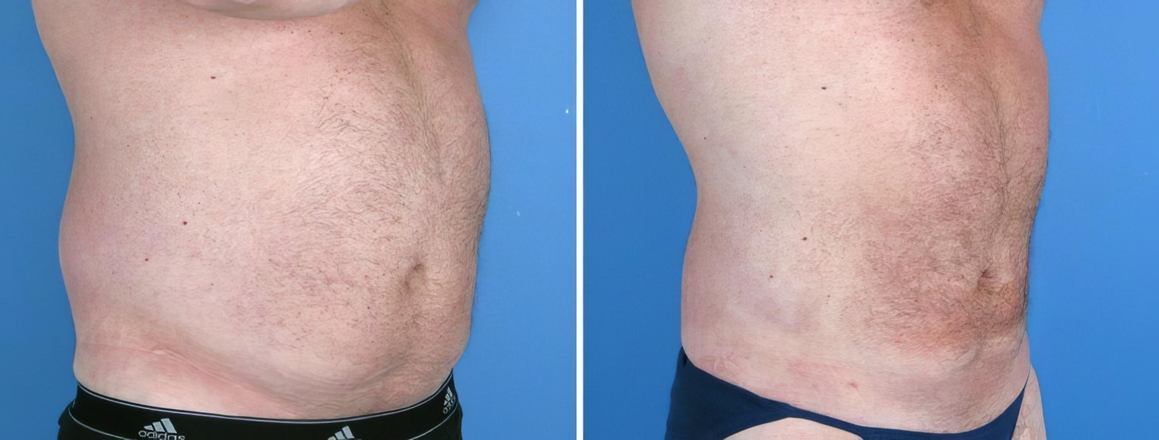 Before & After Liposuction Case 17978 View #2 View in Atlanta, GA