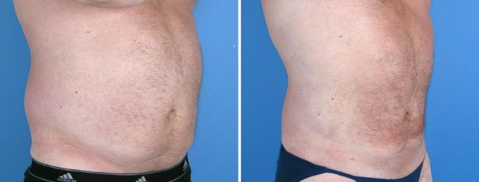 Before & After Liposuction Case 17978 View #2 View in Alpharetta, GA