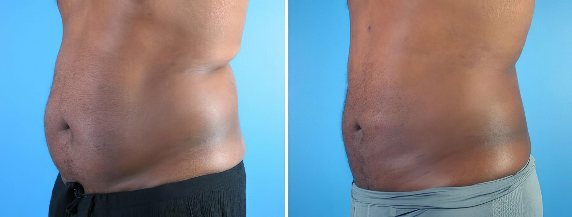 Before & After Liposuction Case 17988 View #1 View in Alpharetta, GA