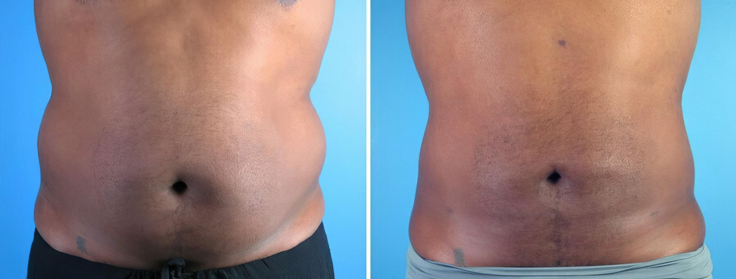 Before & After Liposuction Case 17988 View #2 View in Atlanta, GA