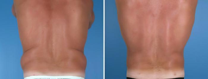 Before & After Liposuction Case 17991 View #1 View in Alpharetta, GA