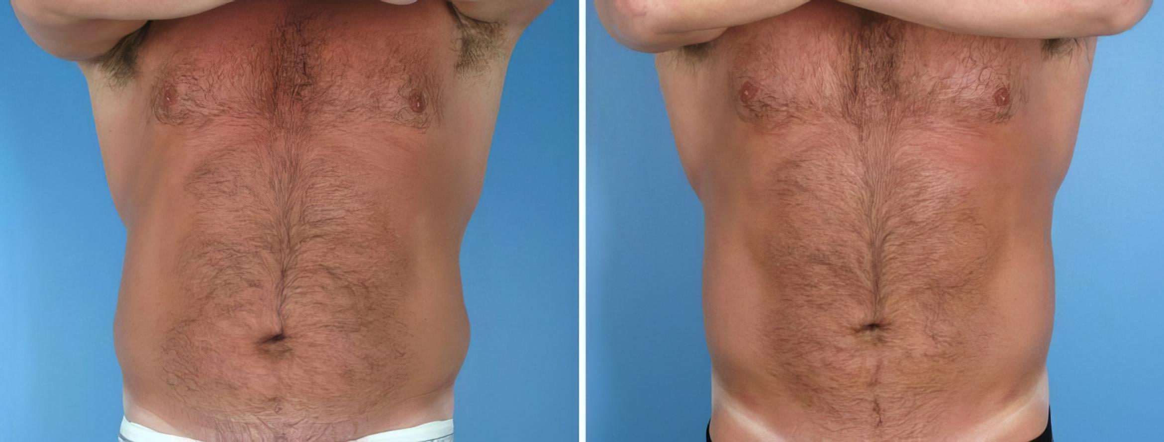 Before & After Liposuction Case 17991 View #2 View in Atlanta, GA