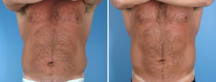 Before & After Liposuction Case 17991 View #2 View in Alpharetta, GA