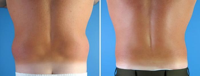 Before & After Liposuction Case 17999 View #1 View in Alpharetta, GA