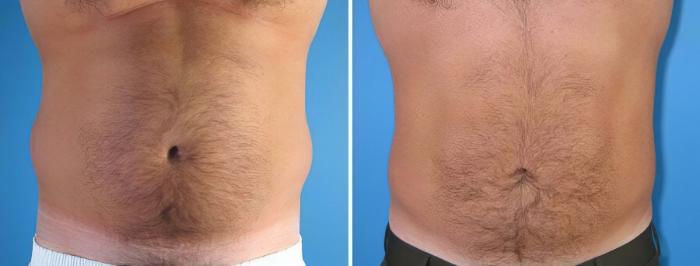Before & After Liposuction Case 17999 View #2 View in Alpharetta, GA