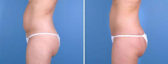 Before & After Liposuction Case 18002 View #1 View in Alpharetta, GA
