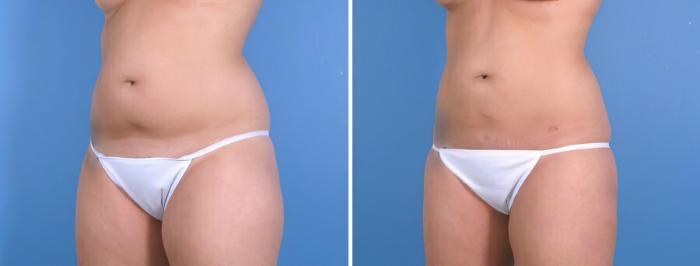 Before & After Liposuction Case 18002 View #2 View in Alpharetta, GA