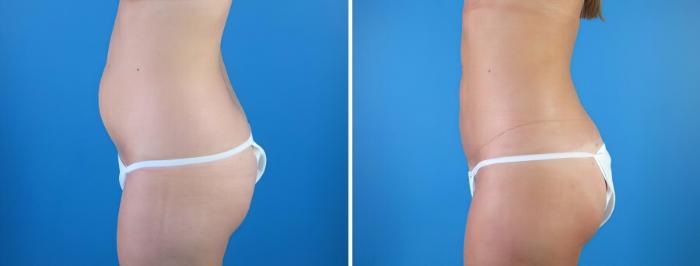 Before & After Liposuction Case 18005 View #1 View in Alpharetta, GA