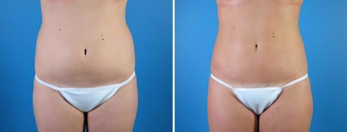 Before & After Liposuction Case 18005 View #2 View in Alpharetta, GA