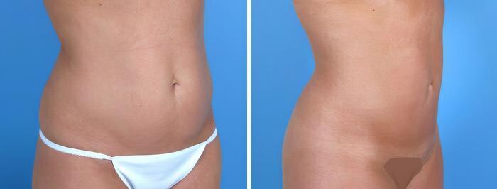 Before & After Liposuction Case 18011 View #1 View in Alpharetta, GA
