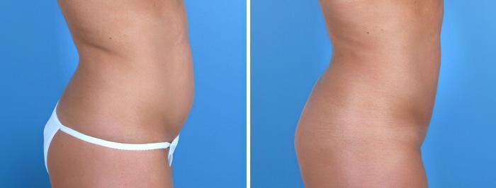 Before & After Liposuction Case 18011 View #2 View in Alpharetta, GA