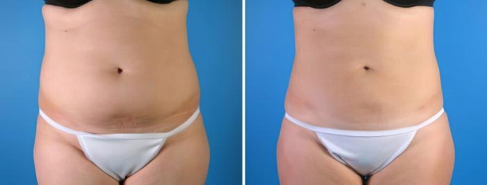 Before & After Liposuction Case 18020 View #2 View in Alpharetta, GA