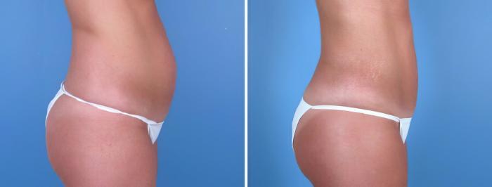 Before & After Liposuction Case 18026 View #1 View in Alpharetta, GA