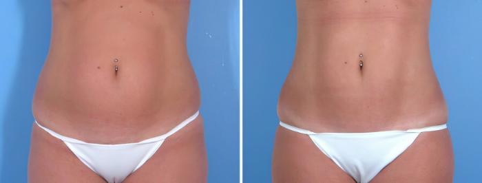 Before & After Liposuction Case 18026 View #2 View in Alpharetta, GA