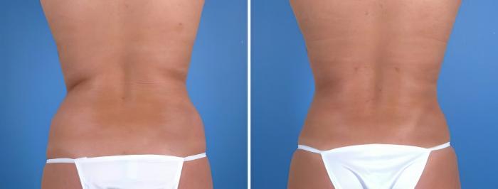 Before & After Liposuction Case 18040 View #1 View in Alpharetta, GA