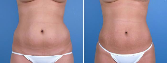 Before & After Liposuction Case 18040 View #2 View in Alpharetta, GA