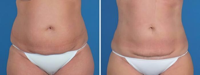 Before & After Liposuction Case 22930 View #1 View in Alpharetta, GA