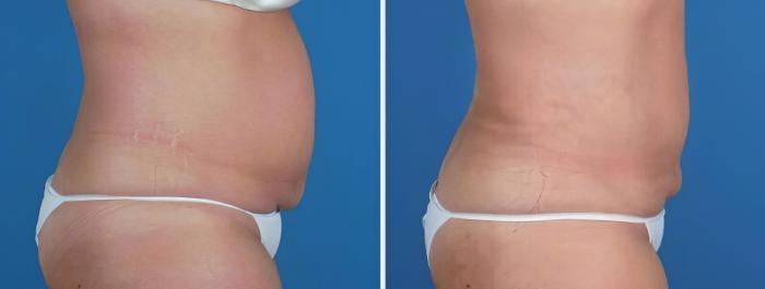 Before & After Liposuction Case 22930 View #2 View in Alpharetta, GA