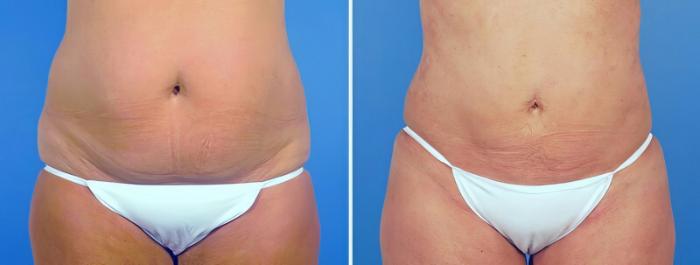 Before & After Liposuction Case 25228 View #1 View in Alpharetta, GA