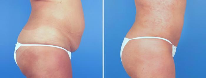 Before & After Liposuction Case 25228 View #2 View in Alpharetta, GA