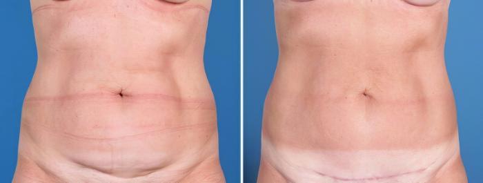 Before & After Liposuction Case 25642 View #1 View in Alpharetta, GA
