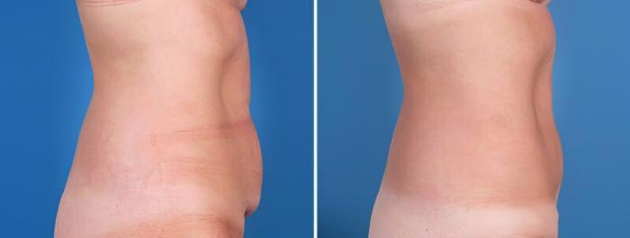 Before & After Liposuction Case 25642 View #2 View in Alpharetta, GA