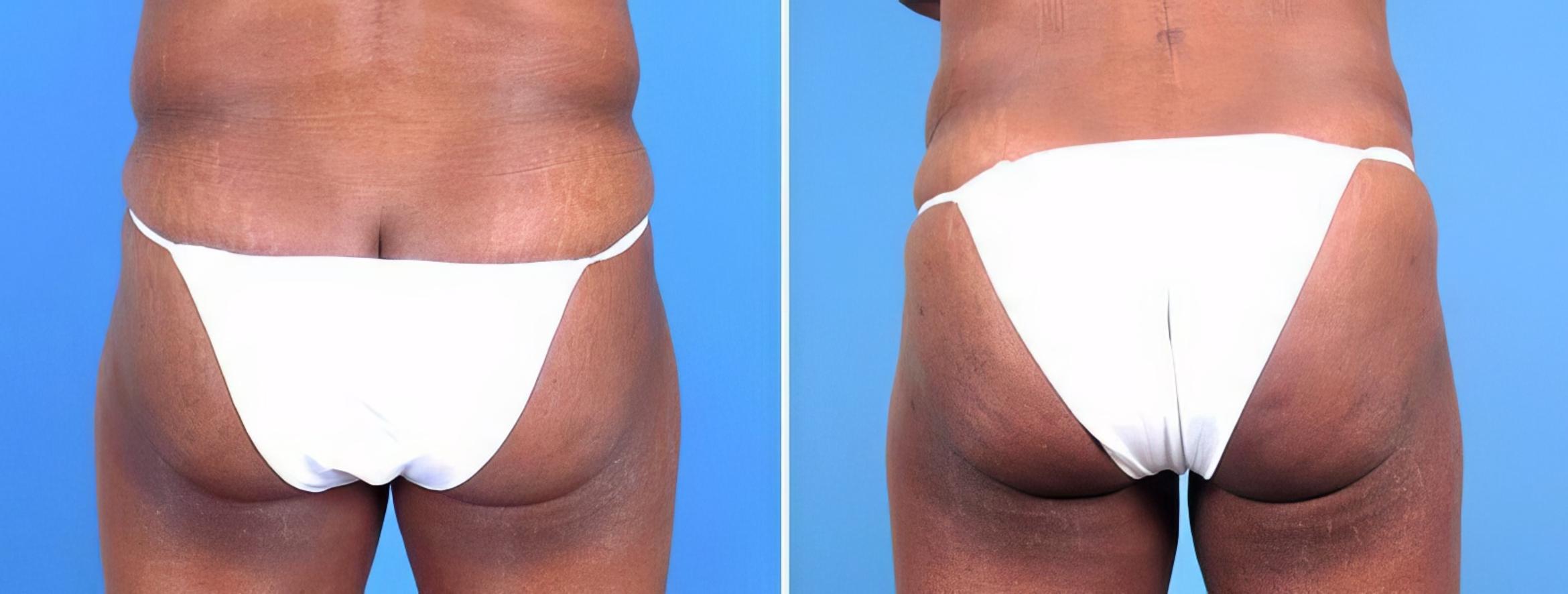 Before & After Liposuction Case 25657 View #1 View in Alpharetta, GA