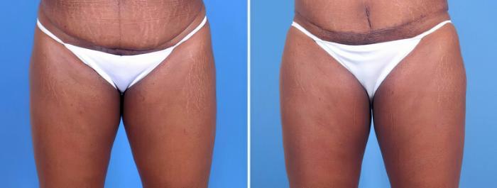 Before & After Liposuction Case 25657 View #2 View in Alpharetta, GA