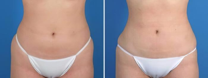 Before & After Liposuction Case 25665 View #1 View in Alpharetta, GA