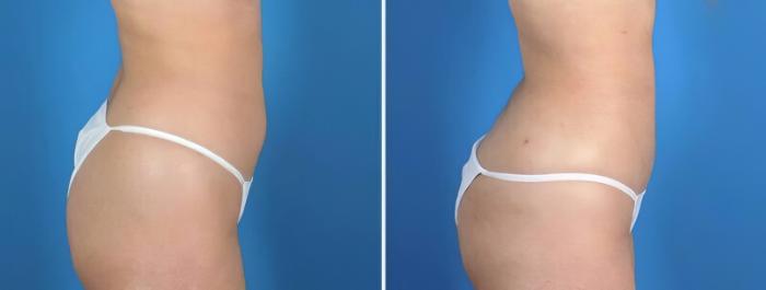 Before & After Liposuction Case 25665 View #2 View in Alpharetta, GA